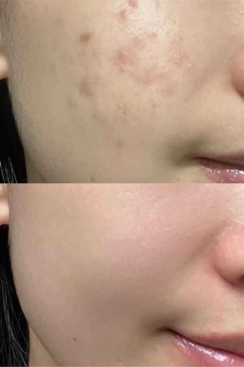 kotoha_cosmeko's tweet photo. ガチで広まってほしいので何度でも言います。

白ニキビ、赤ニキビに悩んでる人‼️
スキンケア、とりあえずこれ見直して。
ニキビができるたびに焦って色々塗るより、これ一個で大丈夫。

K-popのカズハちゃんも言ってるから信じて。 https://t.co/SYLgzmFPw8