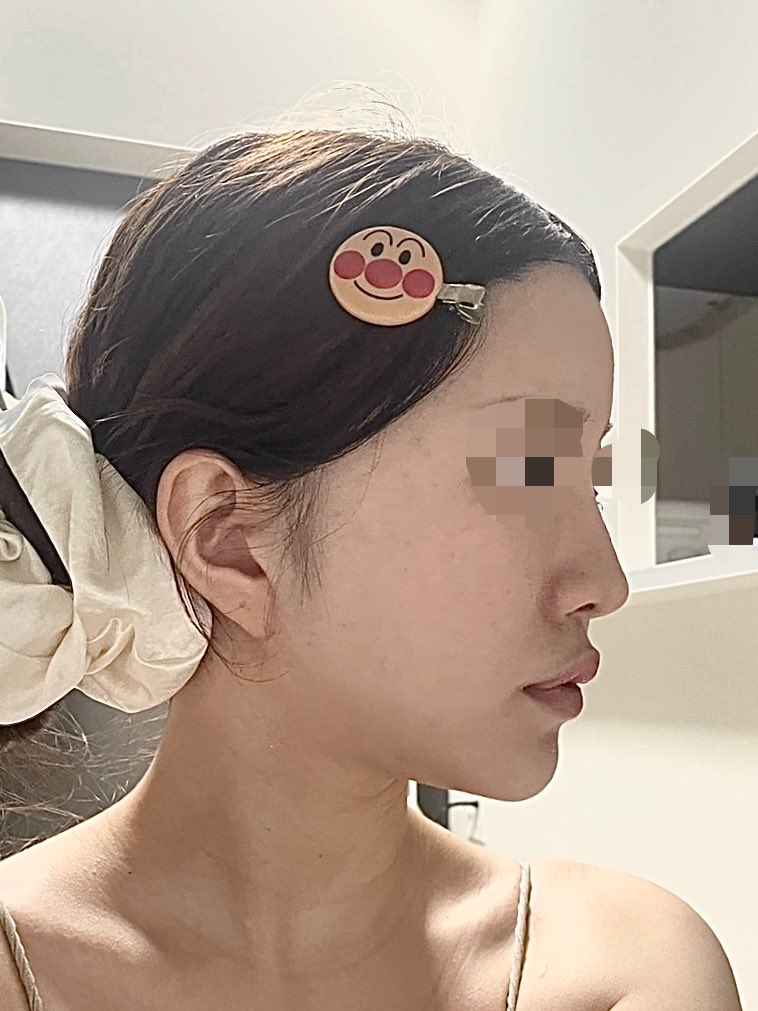 3oo0xim's tweet photo. 鼻フル再手術レポ DT2ヶ月

大きな腫れはほとんど引いてきました！
浮腫みの影響か毎日違って見えるので経過が楽しみです🎶
FINT美容外科で施術しました！

←After     Before→

#渡韓整形　#鼻フル https://t.co/AbYgmdSK2S