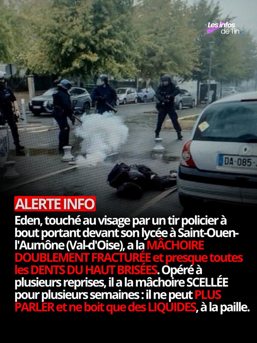 PDohen's tweet photo. 🚨🚨➡️🇫🇷ALERTE INFO - Eden, touché par un tir policier, a la MÂCHOIRE DOUBLEMENT FRACTURÉE et presque toutes les DENTS DU HAUT BRISÉES. Opéré à plusieurs reprises, il a la mâchoire SCELLÉE pour plusieurs semaines : il ne peut PLUS PARLER et ne boit que des LIQUIDES, à la paille https://t.co/OQaCztNeKD