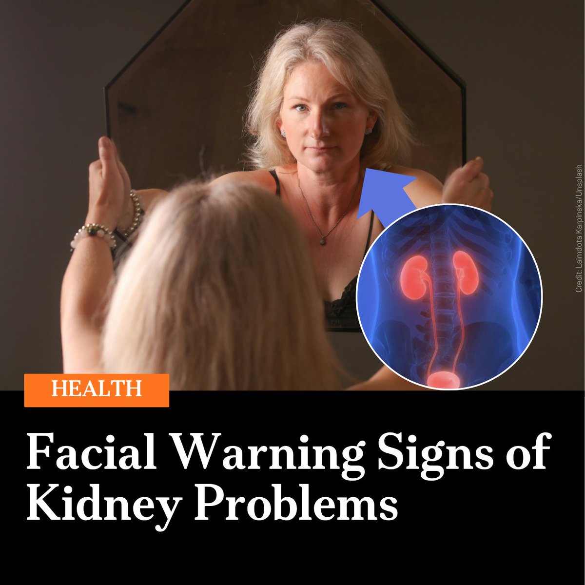 EpochTimes's tweet photo. 🚨Facial Warning Signs of Kidney Problems

Read more