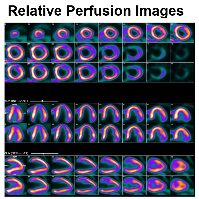 MyASNC's tweet photo. New #ThinkPET case!  Female, age 65, with gallbladder cancer on chemo with declining LV function underwent regadenoson F-18 flurpiridaz PET MPI. Stress & rest ejection fraction: 52% and 51% respectively (similar to echo). Negative troponin & NT-pro BNP. What is the next step in management of this patient? Vote below.