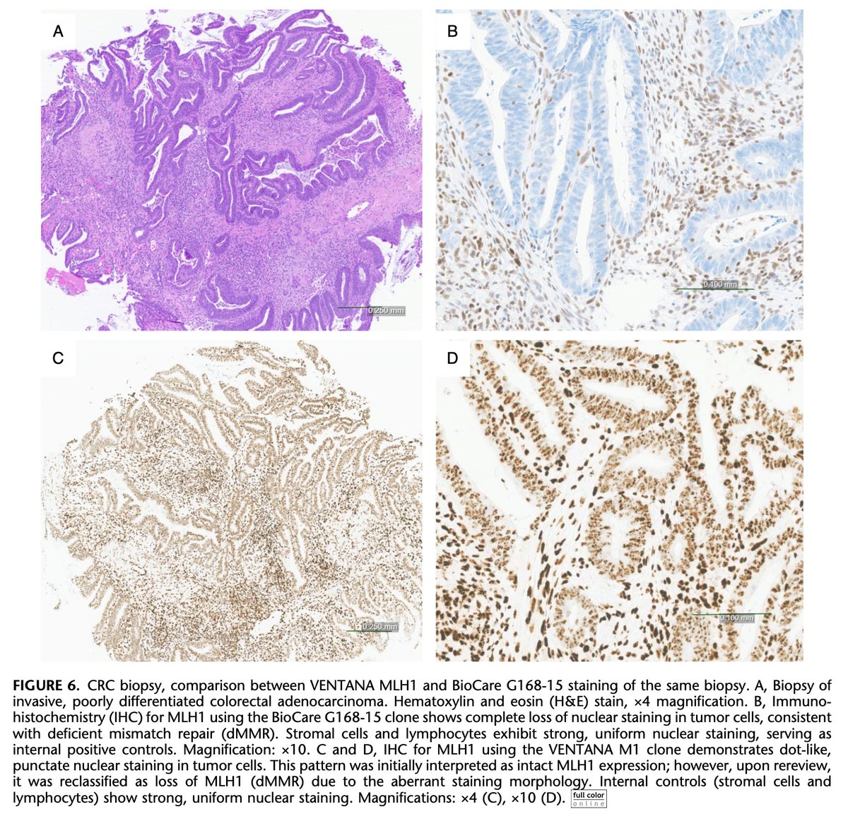 katcollmd's tweet photo. New article out now #AIMMhighlights
▶️ Punctate MLH1 staining with VENTANA M1 can mimic retained expression 
▶️ Alternate clone confirmed MLH1 loss in all 11 dMMR cases 
▶️ Recognize this pitfall: 4/11 cases were initially misread as MMR-proficient https://t.co/LMBuicTnYW