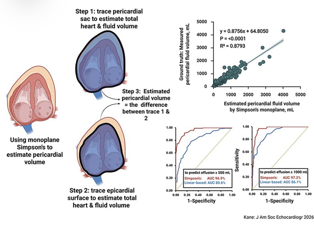 purviparwani's tweet photo. 🫀 Are we measuring pericardial effusions the wrong way?

We routinely classify pericardial effusions as small, moderate, or large based on linear measurements.

But does a single measurement in millimeters accurately represent the actual volume of pericardial fluid?
Study in @JournalASEcho challenges this 

https://t.co/rRPvXe1xMI

🔬 245 patients undergoing pericardiocentesis

Median drained volume: 500 mL (range 50–4,300 mL)
76.7% had cardiac tamponade
Actual drained volume served as the reference standard.

📊 How did different echo methods perform?

Between end diastolic thickness, plax and PSAx area- apical 4 chamber Simpson’s volumetric estimation performed the best

✅ Accuracy: 80.4% vs 49.4%

Perhaps it is time to rethink how we quantify pericardial effusions!

💡 if volumetric assessment is substantially more accurate, should we move from millimeters to milliliters in routine echocardiography?

And more importantly, would this change clinical decision-making—or simply improve the precision of our reports?

#EchoFirst #CardioTwitter #CVImaging