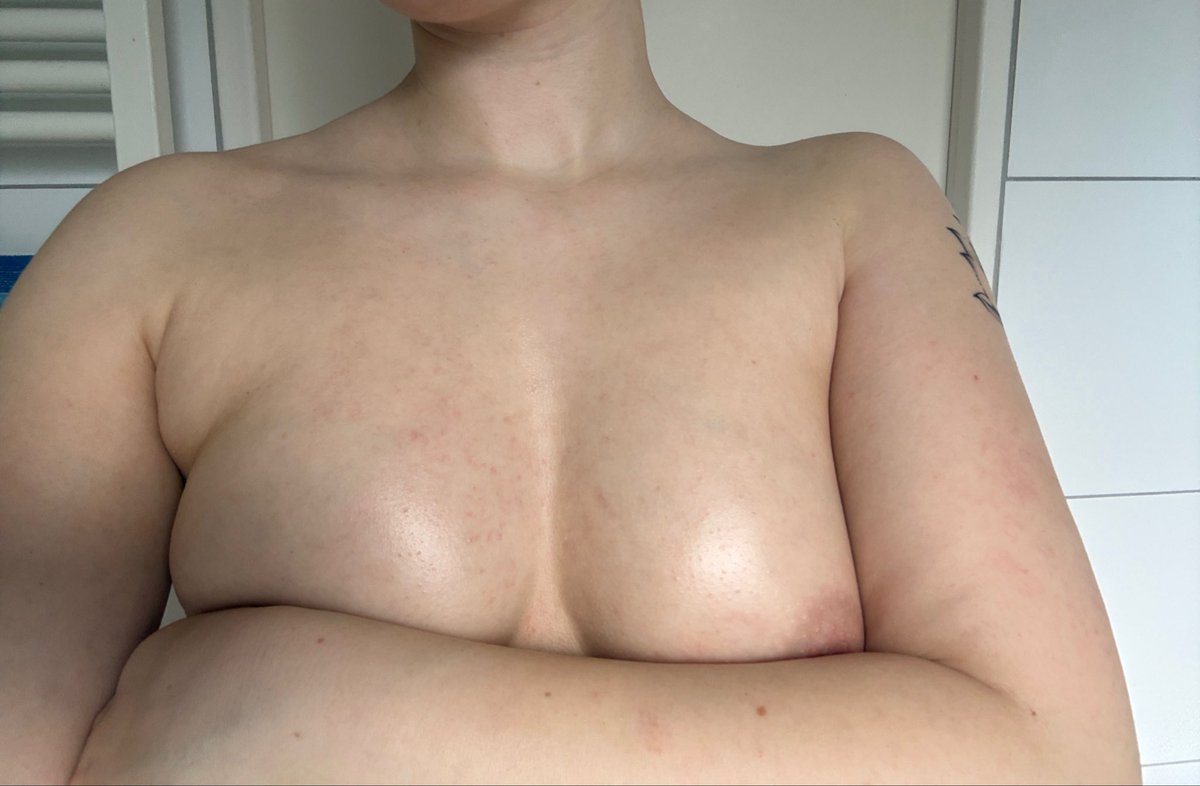 cherry_thefrui's tweet photo. Ignore my flare up😞 fresh out the showerrr #nsfwtwt https://t.co/ynLnA6I5cv