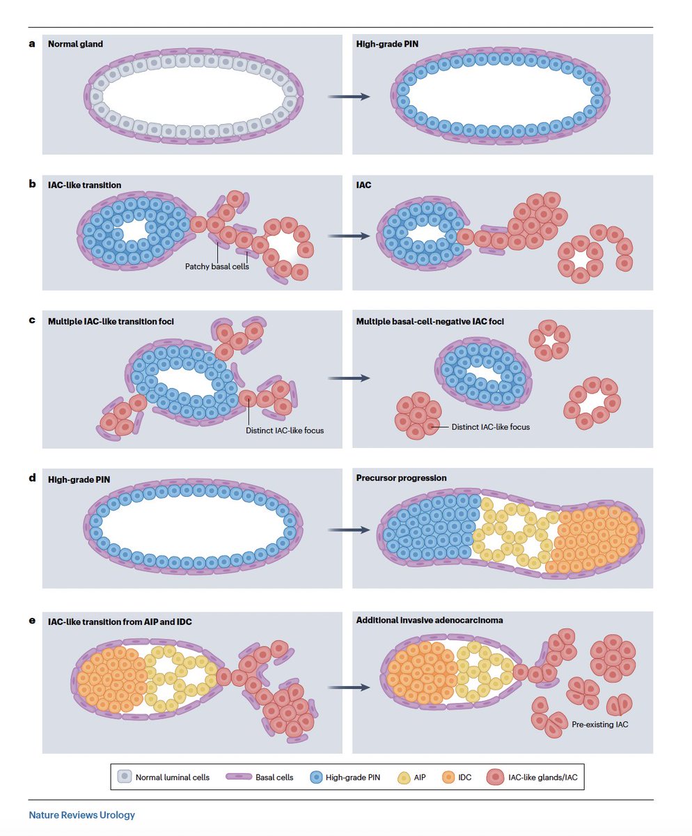 Adam_Weiner535's tweet photo. 🚨 New review in @NatRevUrol 🚨

🔬Cribriform & intraductal carcinoma (IDC) of the prostate: the high-risk histology

@ruimmbernardino 

🧬 IDC + invasive cribriform independently predict adverse path, mets & PCa death, 
🔎 Biopsy catches them in only ~half of men who harbor them, and MRI targeting doesn't close the gap
📈 Prevalence climbs w/ risk: ~2% in low-risk to >50% in metastatic/recurrent
🧪 Enriched for PTEN loss, DDR alterations, genomic instability & an immune-cold, fibroblast-rich niche

🎯 Bottom line: It should be reported and more is to come on how it should factor into decision making
🔗 https://t.co/8v3V4jc4YY

@AmerUrological @UroOnc @urotoday @UrologyTimes @PCF_Science