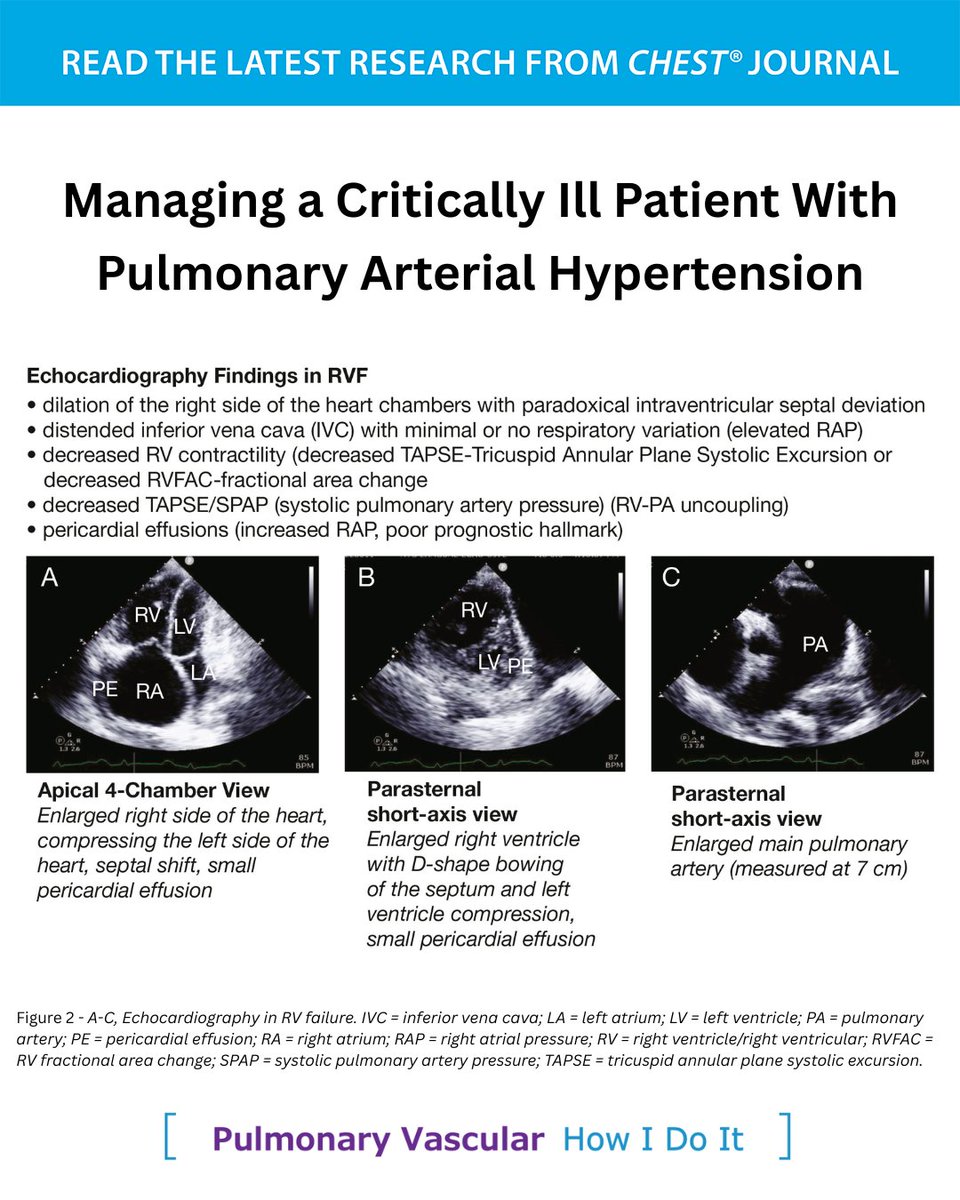 accpchest's tweet photo. The latest CHEST How I Do It focuses on the management of acute decompensated right ventricular failure in patients with known pulmonary arterial hypertension.

Read the article in the October issue of the journal CHEST®: https://t.co/YTJxPtg4gZ
#MedEd #JournalCHEST https://t.co/9FbPEEfyVU