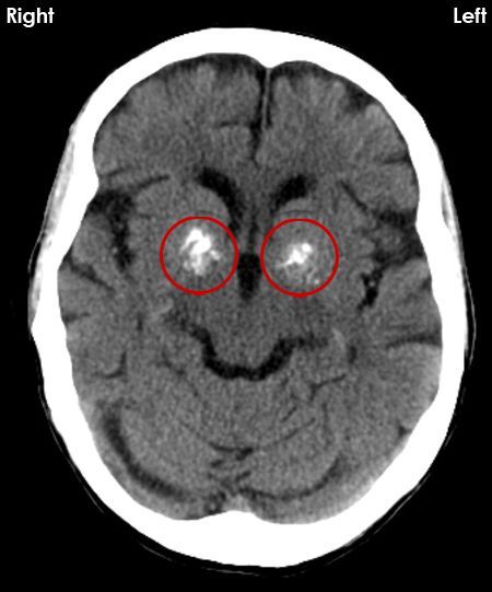 RadMasterclass's tweet photo. CT BRAIN 3: What are the white (calcified) structures ringed and what other structures seen on CT brain images can be considered normal if calcified? Answer https://t.co/g5Ypjyk1Bs https://t.co/BrpJkluYbM