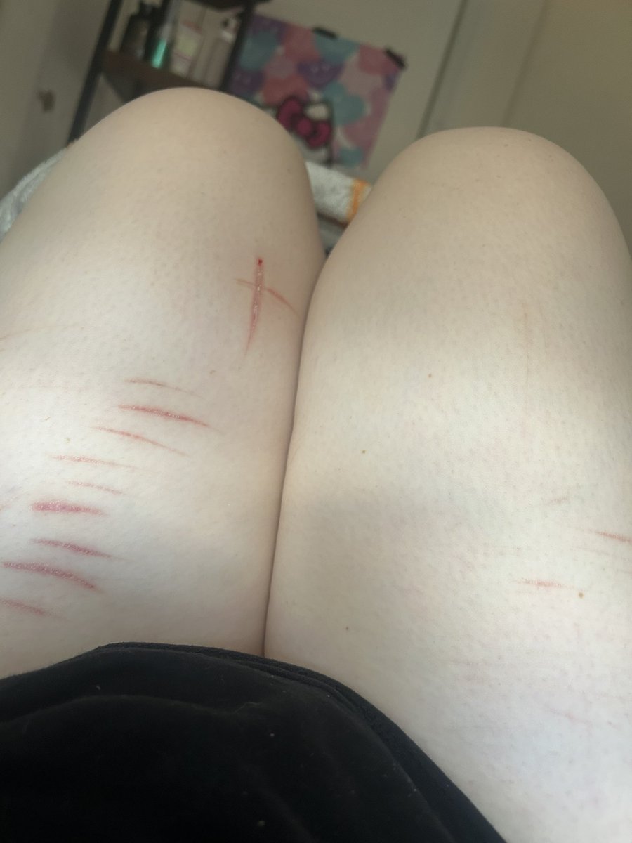 niineteenforevr's tweet photo. my FAKE scars 
#shedrtwt #shhtwt #scars #basicdni https://t.co/ESY87iE59n