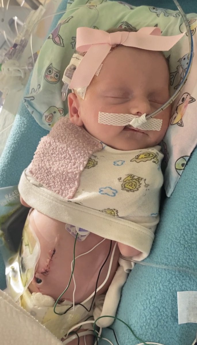 uihealthcare's tweet photo. Callie was born almost six weeks early at a local hospital in 2024, but was flown to our hospital when doctors discovered she had air in her abdomen. An exploratory surgery when she was 2 days old resulted in an appendectomy — and made her the youngest female in the world to have the surgery, according to Guinness World Records! 🥇