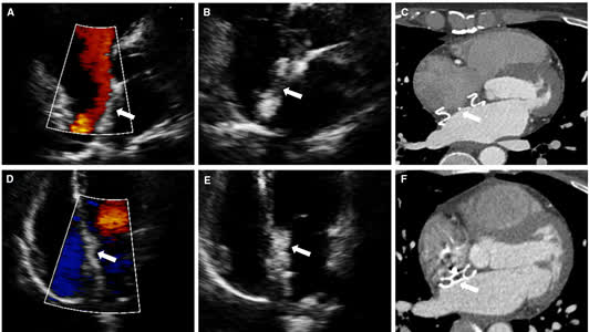 JAHA_AHA's tweet photo. A novel puncturable ASD occluder showed noninferior closure efficacy with reduced device thickness and lower early migraine burden. https://t.co/SZTwjbxme8 https://t.co/mjwEpycb9C