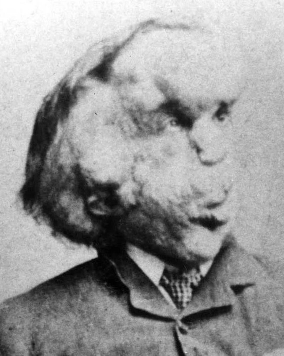 Cultination1's tweet photo. 🇬🇧🚨 Surnommé l’HOMME-ÉLÉPHANT, il est MORT en voulant dormir ALLONGÉ comme tout le monde !

Le 11 avril 1890, Joseph Merrick meurt à Londres, à 27 ans. Depuis ses 5 ans, son corps se déforme. On l’a même exhibé comme une bête de foire.

Chaque nuit, il dort assis, le front posé sur ses genoux. Mais il rêve de faire comme les autres. Ce jour-là, il s’allonge. Sa tête bascule en arrière et lui déboîte le cou.

(Hektoen International)