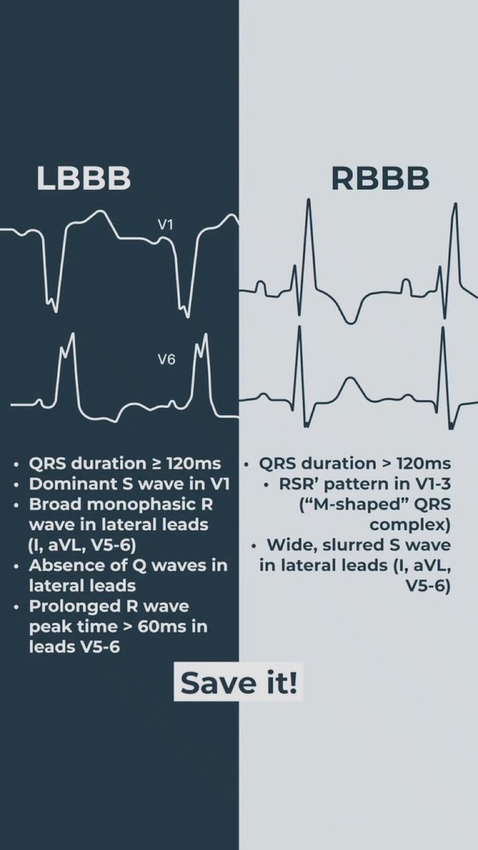 DrPharmDMDTh's tweet photo. LBBB vs. RBBB https://t.co/gNSaGv0GCN