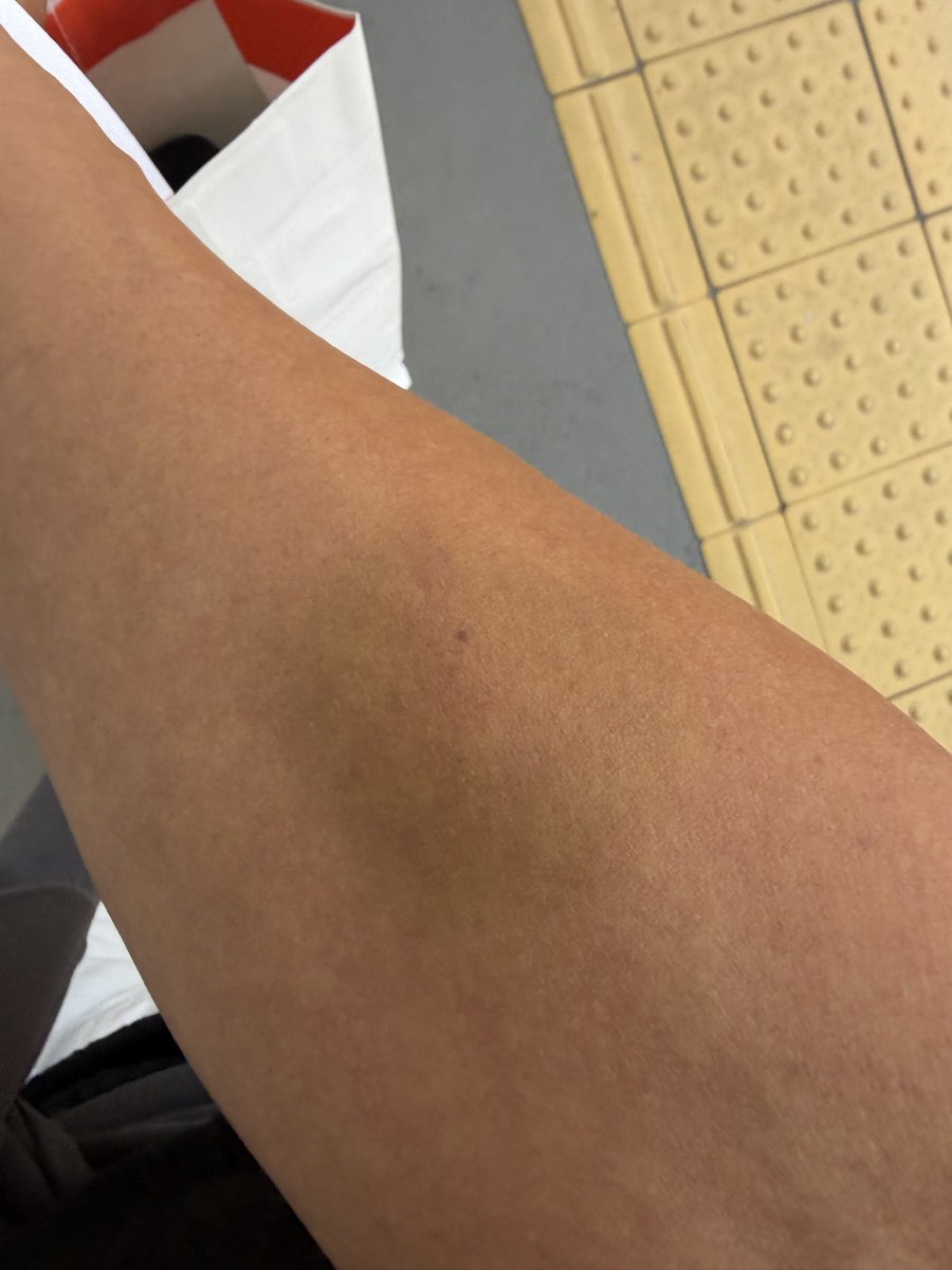 Truedy_1's tweet photo. 噛まれた😰 https://t.co/t0HSrmMMBr