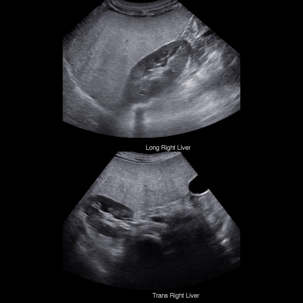 pedsimaging's tweet photo. Toddler with abdominal pain
Sagittal (above)+transverse (below) US of liver show diffusely increased echogenicity of liver parenchyma when compared to right kidney parenchyma
#FOAMRad #PedsRad #RadEd #radiology #pediatrics #radiologia #PedSurg #SoMe4PedSurg #Ultrasound https://t.co/BX6x4WyxeX
