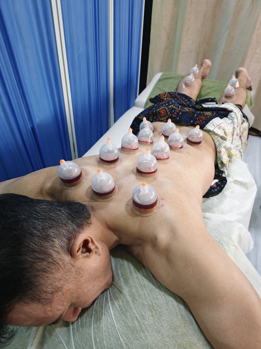 AbangOmar's tweet photo. selesai sessi Bekam
(bekam darah & bekam angin)
#bekam #cupping #healthy
#sunnahrasulullahsaw https://t.co/GdEz2sUL3L