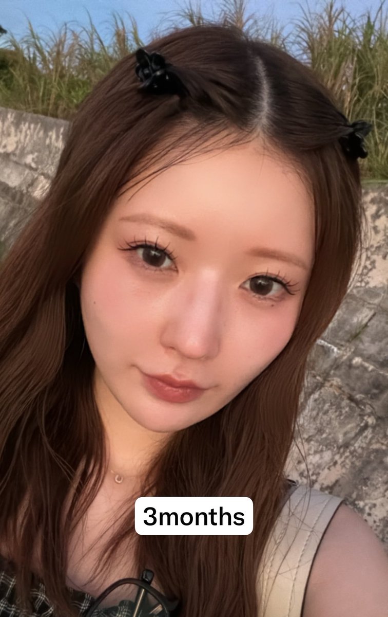 dr_omiomi's tweet photo. 浜辺美波さんが圧倒的に綺麗な理由。

それは「顔の余白の少なさ」と「透明感」です。

実は、垢抜けに大切なのは目や鼻のパーツだけではありません。

①【余白】
輪郭を整え、中顔面・下顔面の余白を減らすことで、相対的に目鼻立ちが際立つ。

②【透明感】
透明感＝肌の白さではありません。
重要なのは「水分量・毛穴・キメ・色むら」。

肌育製剤（リトゥオ・プルリアル、ネオファウンドなど）、水光注射、ボトックス、IPL(ステラM22XPL)・レーザーなどで肌質を整えることが大切です。

垢抜けの本質は「パーツを大きくすること」ではなく、「輪郭×肌質」を整えること。

普段から肌育、レーザーを行ってるスタッフの糸リフト経過✨(経過なので自撮りと他撮りが混ざってるので参考にしてください。)