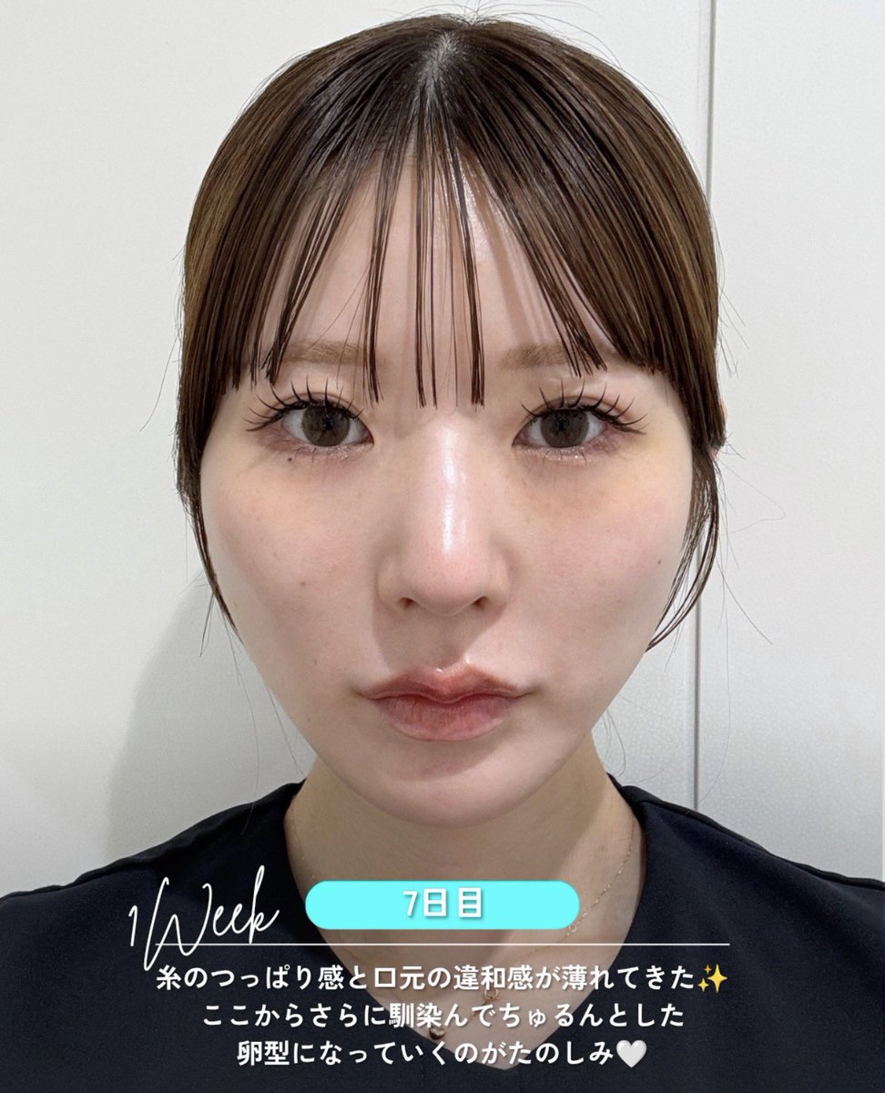 dr_omiomi's tweet photo. 浜辺美波さんが圧倒的に綺麗な理由。

それは「顔の余白の少なさ」と「透明感」です。

実は、垢抜けに大切なのは目や鼻のパーツだけではありません。

①【余白】
輪郭を整え、中顔面・下顔面の余白を減らすことで、相対的に目鼻立ちが際立つ。

②【透明感】
透明感＝肌の白さではありません。
重要なのは「水分量・毛穴・キメ・色むら」。

肌育製剤（リトゥオ・プルリアル、ネオファウンドなど）、水光注射、ボトックス、IPL(ステラM22XPL)・レーザーなどで肌質を整えることが大切です。

垢抜けの本質は「パーツを大きくすること」ではなく、「輪郭×肌質」を整えること。

普段から肌育、レーザーを行ってるスタッフの糸リフト経過✨(経過なので自撮りと他撮りが混ざってるので参考にしてください。)