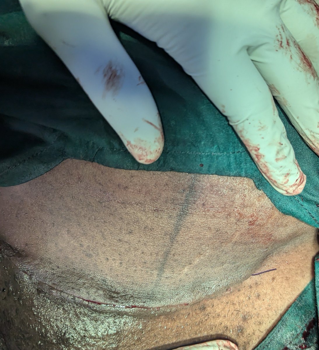 psych_Haven's tweet photo. A small line, but a significant journey. Behind every Caesarean scar is a story of courage, at let us make the scar look better. https://t.co/dIhd8EubHA