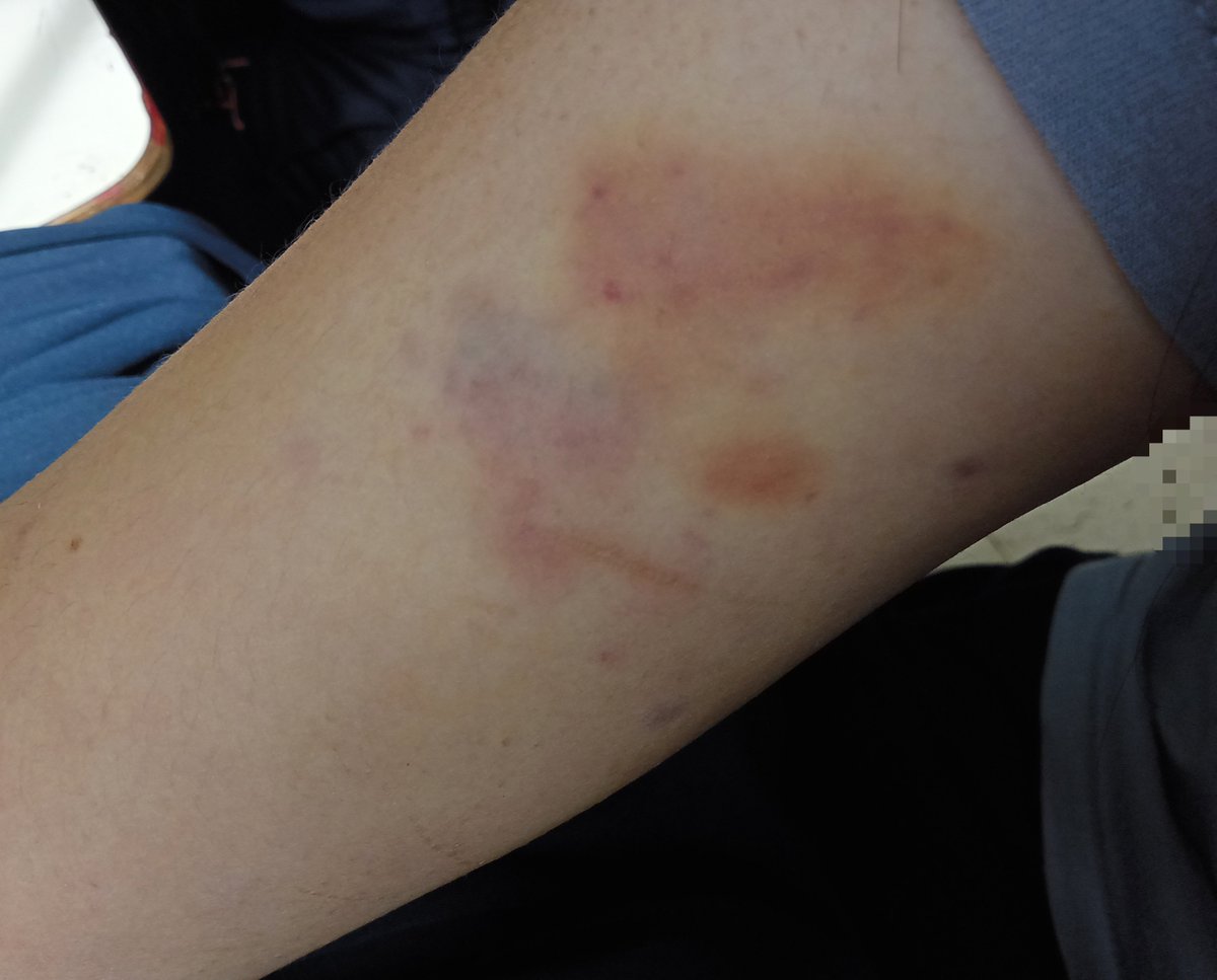 cel1mp's tweet photo. I love how bruises look https://t.co/QY6uRp5Ftg