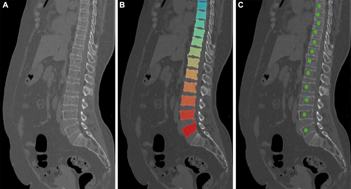 RadioGraphics's tweet photo. There’s more information in every CT scan. Opportunistic screening can extract biomarkers such as bone density, body composition and vascular calcification from existing imaging, expanding radiology’s role in proactive patient care. @SidDograMD @NYUImaging https://t.co/DEotMtlvUp https://t.co/oQR1R4gXcy