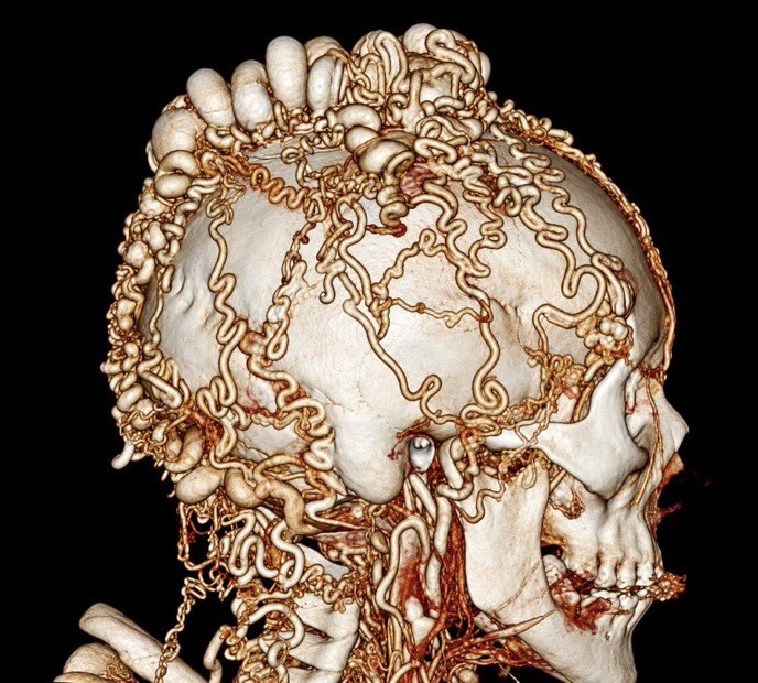 Zypph3rrr's tweet photo. Patient presents with large pulsating bulge on head. 3-D CT reconstruction showed this. What is your diagnosis? https://t.co/JAaclfhFUa