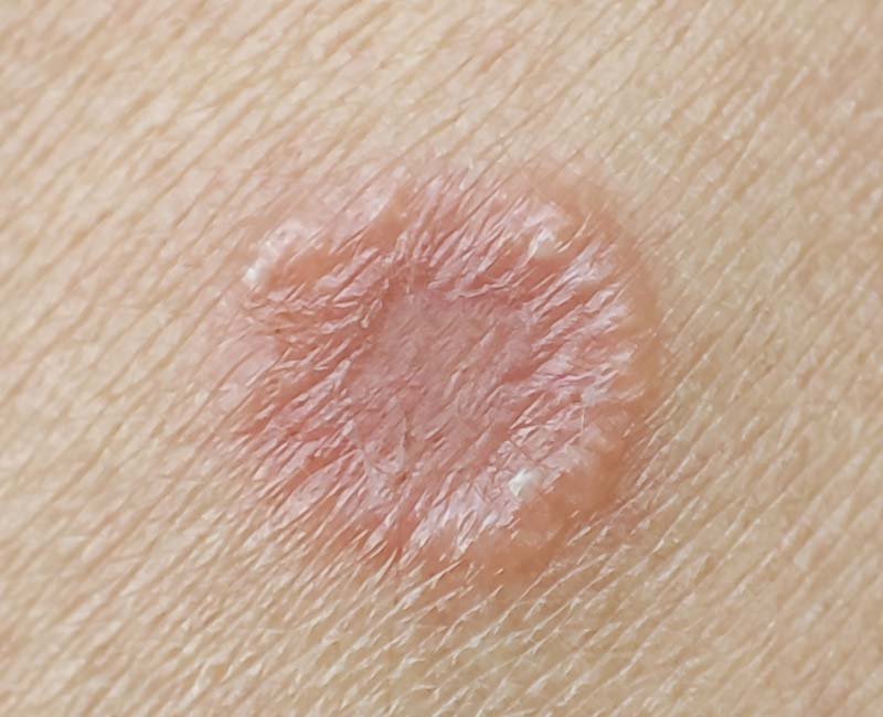 DestinyRebound's tweet photo. 🍄 Fungal Skin Infection? Don’t Ignore the Itch!

✅ Keep your skin clean and dry.
✅ Avoid sharing towels and clothes.
✅ Choose the right treatment!

📖 Learn more 👇
https://t.co/2UAdAUYKwR

#FungalInfection #SkinCare #HealthySkin #٢��٣٠_بلا_نقاب13 https://t.co/RjXRV1k0G8