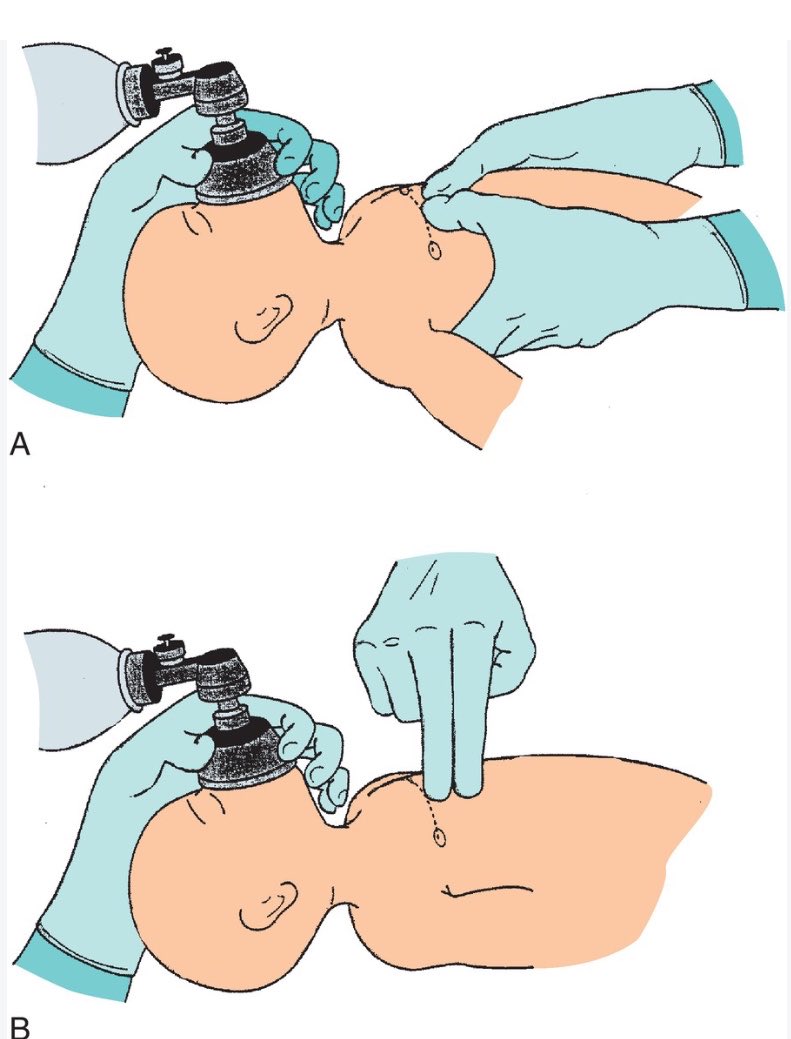 CorpusAlienumm's tweet photo. RESUSITASI NEONATUS IDAI 2022

Terdiri dari 5 blok besar :
1. Persiapan resusitasi
2. Langkah awal & manajemen jalan napas
3. Bantuan napas 
4. Bantuan sirkulasi
5. Bantuan obat

1. Persiapan Resusitasi 
- Pertanyaan : usia kehamilan, warna ketuban, jumlah janin, faktor resiko (ibu, bayi, intrapartum)
- Edukasi pasien : informed consent
- Tim : Leader, asisten sirkulasi, asisten obat
- alat dan obat (alat : Termoregulasi, Airway, Breathing, Circulation, Drugs, Others)

Persiapan tim
- Leader (Airway & Breathing) : memberikan arahan, suction, pemasangan intubasi bila perlu, dan breathing (oksigenasi)
- Asisten sirkulasi : sebelah kiri, memeriksa LDJ, RJP bila diperlukan
- Asisten obat dan alat : sebelah kanan, memberikan obat, pasang akses vena atau umbilical, loading cairan NS, PRC

Persiapan alat >> (TABCDO, Termoregulasi, airway & breathing, circulatuon, drugs, others)
- Termoregulasi : infant warmer, kain 3 lapis, topi dan plastik (untuk BBL <1500 gram), suhu ruangan resusitasi 23-25 celcius
- Airway & Breathing : Suction (no 12 Fr jika ketuban meconeal), sungkup berbagai ukuran, Laringoskop miller (00 jika BBL <1000 gram/UK <28 minggu, 0 jika BBL 1000-2000 gram/UK 28-34 minggu, 1 jika BBL >2000/aterm), ETT (nomor 2,5 BBL <1000 gr, 3 BBL 1000-2000 gr, 3,5 BBL 2000-3000 gr, 4 BBL >3000 gr), ambubag, jackson reese, T-piece resuscitator, Oksigen ready and flowing
- Circulation : stetoskop, umbilical catheter set, pulse oxy, EKG
- Drugs : epinephrine 1:10.000, NS, naloxone, PRC sesuai indikasi
- Others : Vit K, Clamp, gunting, plester, tali

2. Langkah awal & manajemen jalan napas

- Penilaian awal : Prematur? Napas irreguler? Menangis lemah? Tonus lemah? >> jika tidak langsung rawat gabung dengan ibu
- Jika salah 1 ya, langkah awal resusitasi (HAIKAN) >> H hangatkan, Atur posisi menghidu, Isap lendir blila perlu, Keringkan, Atur posisi kembali, Nilai (usaha napas, frekuensi jantung, dan saturasi preduktal, serta rangsang nyeri)

Dari penilaian awal sampai HAIKAN 30 dtk!!!

Penilaian : bernapas normal? Retraksi? Megap-Megap? ATAU cek LDJ dengan stetoskop 6 detik dikalikan 10

3. Bantuan napas

Jika bayi megap/megap atau LDJ <100 lakukan VTP
- VTP frekuensi 40-60x/ menit : tekan… lepas… lepas…
- Teknik CE clamp, posisi menghidu
- Atur FiO2 : aterm (>= 35 mgg) 21%, prematur 21-30%
- PIP/PEEP: >32 mgg PIP 25-30 PEEP 5, <32 mgg PIP 20-25 PEEP 5
- Flowmeter 10 L/mnt

Lakukan selama 15 detik, syarat VTP berhasil : dada mengembang, LDJ meningkat, SpO2 meningkat (lihat tabel target saturasi preduktal)

Jika VTP tidak berhasil/tidak efektif : SRIBTA
S sungkup perbaiki
R reposisi jalan napas
————————————VTP 3-4x, jika tidak berhasil
I isap lendir (mulut kemudian hidung)
B buka mulut dan bersihkan jika ada obstruksi
————————————VTP 3-4x, jika tidak berhasil
T tekanan naikkan (maksimal PIP 40 cmH2O)
————————————VTP 3-4x, jika tidak berhasil
A alternative airway : LMA, intubasi >> bila VTP gagal terus, LDJ tidak jelas, kondisi khusus : Hernia Diafragma Kongenital

4. Bantuan sirkulasi

- Jika LDJ <60 x/mnt, lakukan VTP + Kompresi rasio 1:3
- Kompresi kedalaman 1/3 radius anteroposterior dinding dada, 2 jari diatas proc. Xyphoideus
- Sebanyak 3:1 kompresi : ventilasi tiap 2 detik
- Lakukan selama 60 detik dengan jumlah 90 kompresi dan 30 ventilasi
- Setelah 1 menit, nilai LDJ selama 6 detik dikali 10

5. Bantuan obat 

Epinephrine
- IV konsentrasi 1:10.000, dosis 0,1-0,3 mg/kgBB (0,1-0,3 cc/kgBB) + flush 0,9 cc NS
- Endotrakeal : 0,5-1 cc/kgBB
