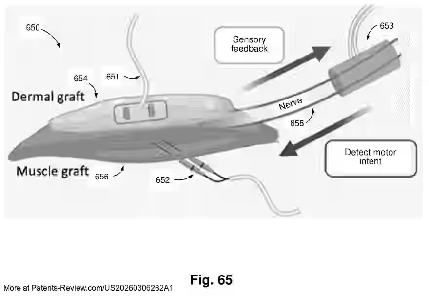 PatentPulse's tweet photo. A muscle cuff can capture nerve signals to control a prosthesis, while a separate skin graft delivers sensory feedback through stimulation.

University of Michigan patent application #US20260306282 #Prosthetics https://t.co/Z6oXIeLCop