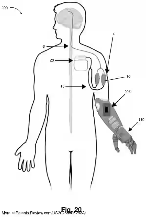 PatentPulse's tweet photo. A muscle cuff can capture nerve signals to control a prosthesis, while a separate skin graft delivers sensory feedback through stimulation.

University of Michigan patent application #US20260306282 #Prosthetics https://t.co/Z6oXIeLCop