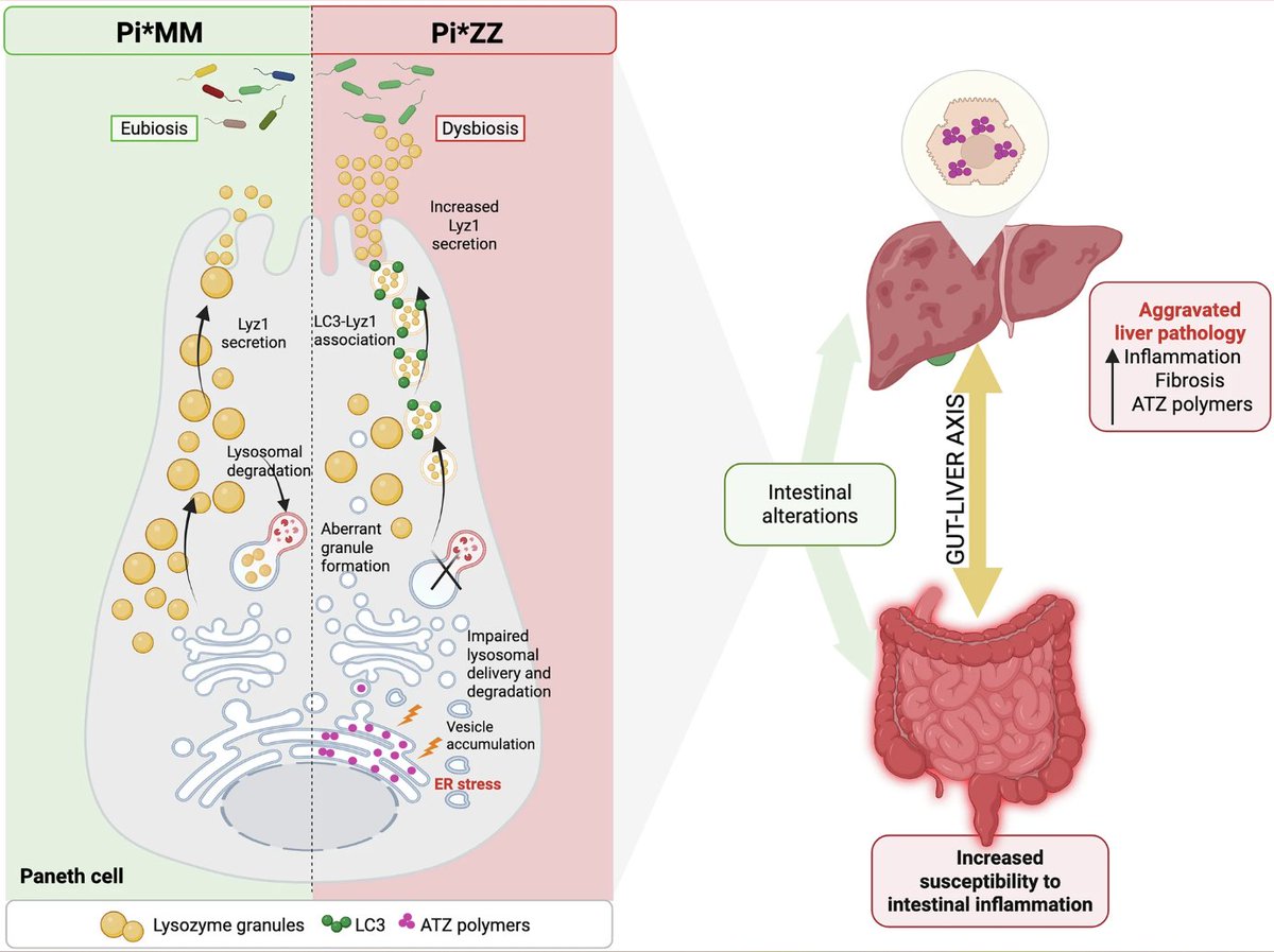 Intestinal_Cell's tweet photo. Data from this study in @sigtrans_sttt reveal a Paneth cell-intrinsic endoplasmic reticulum stress mechanism linking ATZ accumulation to gut epithelial dysfunction, highlighting a previously underexplored role of the gut–liver axis in AAT deficiency.

Read the #OpenAccess paper: https://t.co/EzSYLkEASC

#PanethCell #EndoplasmicReticulum #IntestinalResearch