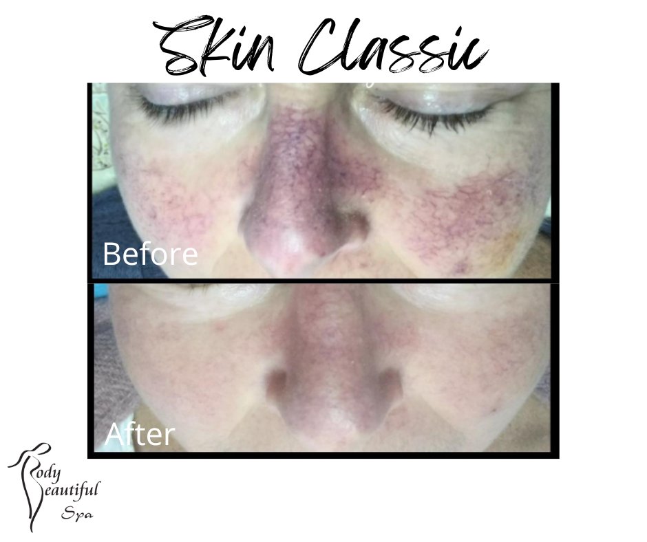 BodyBSpa's tweet photo. Skin Classic for Spider Veins
#Medicalanddayspa #Spanearme #Biltmoremedspa #Scottsdalemedspa #Awardwinningmedspa #Phoenixmedspa #botoxandfillers #toxinsandfillers #AllerganandGalderma #BodyBeautifulSpa https://t.co/2p6tKi7fw2