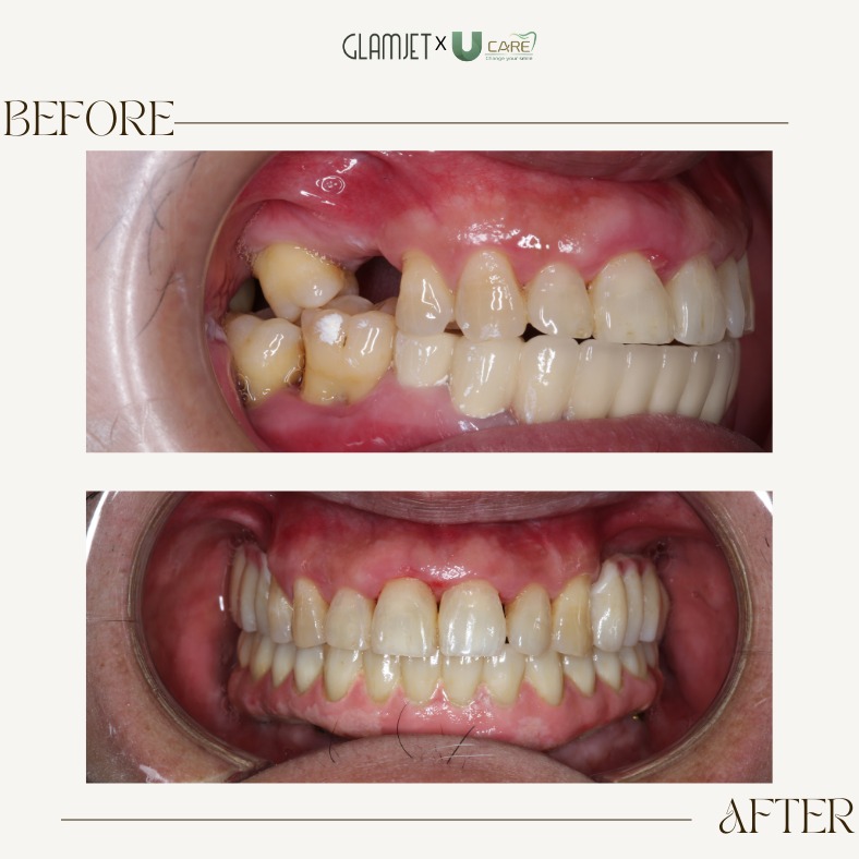 RocioPelayo's tweet photo. Before &amp; After: See the magic of cosmetic dentistry with this stunning transformation at Vietnam Dental Holiday. https://t.co/u0hDtwlOYH