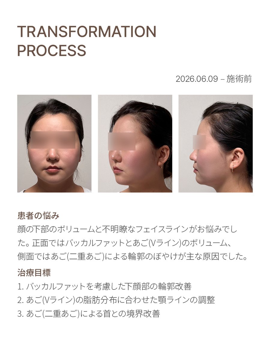 ulineclinic's tweet photo. A MAGAZINE FOR U, VOL.26

顔の特定の部位に集中したボリュームは、顔全体の印象にも影響します。

頬まわりの脂肪は顔を丸く見せることがあり、あごのラインや二重あごの脂肪は、顔の下半分の輪郭を重たく見せることがあります。

Vカット注射は、顔の部位ごとの脂肪の特徴とボリュームを考慮して余分な脂肪にアプローチし、よりすっきりとしたフェイスラインを目指します。

今回のマガジンでは、頬やあごまわりの脂肪が顔の印象に与える影響と、部位ごとの輪郭改善に向けたアプローチについて取り上げました。

➡ いますぐ相談する：https://t.co/HfSfxBaIFu
➡ マガジン：https://t.co/d42hqpQQuH
➡ お問い合わせ電話：☎+82-2-516-7588☎

#カット注射 はユーラインクリニックでのみ施術可能ですので、なりすましクリニックからの被害には十分ご注意ください :)

#ユーラインクリニック #ユーラインマガジン #10月マガジン #マガジン #美容マガジン #顔の脂肪 #Vライン #二重あご #輪郭ケア #フェイスライン #ディープチーク #ユーラインカット注射 #Vカット注射 #分析と測定 #測定に基づくケア