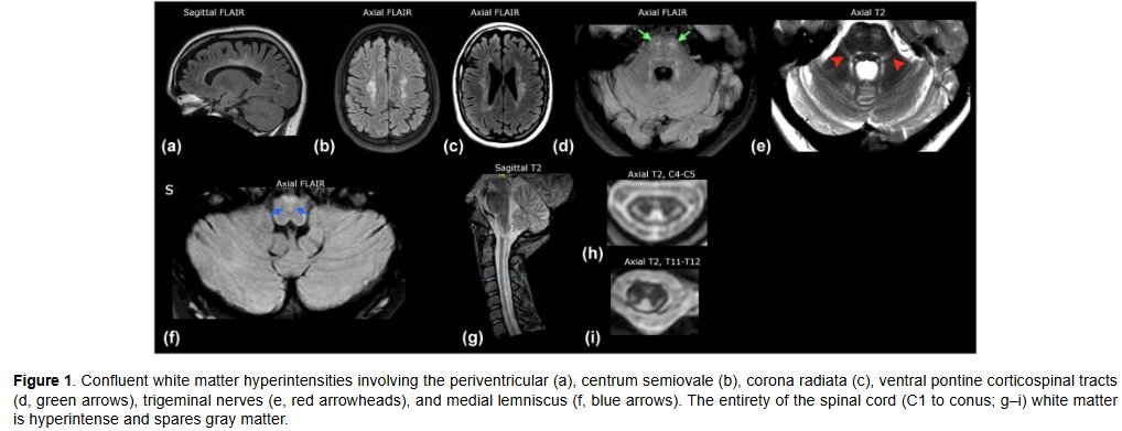 MSJ_Research's tweet photo. A woman in her 20s was referred for demyelinating disease based on white matter lesions on MRI, but was then found to have genetic leukoencephalopathy (LBSL with biallelic DARS2 variants).

Case report from @CLENeurons ▶️ https://t.co/PCxt5Qh4BZ

1/🧵 https://t.co/UTIunNhr07