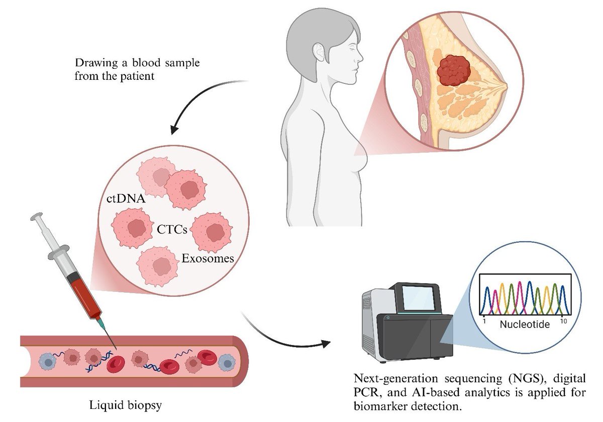 Cancers_MDPI's tweet photo. 🥳1st paper of #SpeicalIssue!
Multi-Omics and #LiquidBiopsy Integration for Precision Stratification of #BreastCancer
Read the paper for free��https://t.co/WooiJQfrIS
Special Issue: https://t.co/JKSyifL5IP https://t.co/pRPTJxeGDz