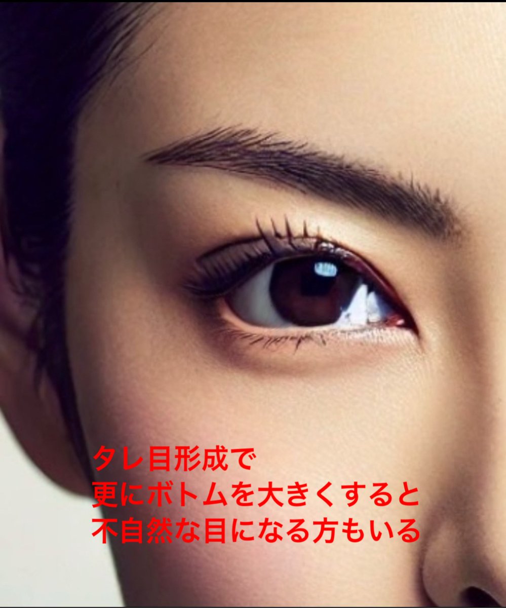 beauty_sub7's tweet photo. タレ目形成で
整形顔になるのは
手技とデザインのせいですね https://t.co/imxDMoihs1