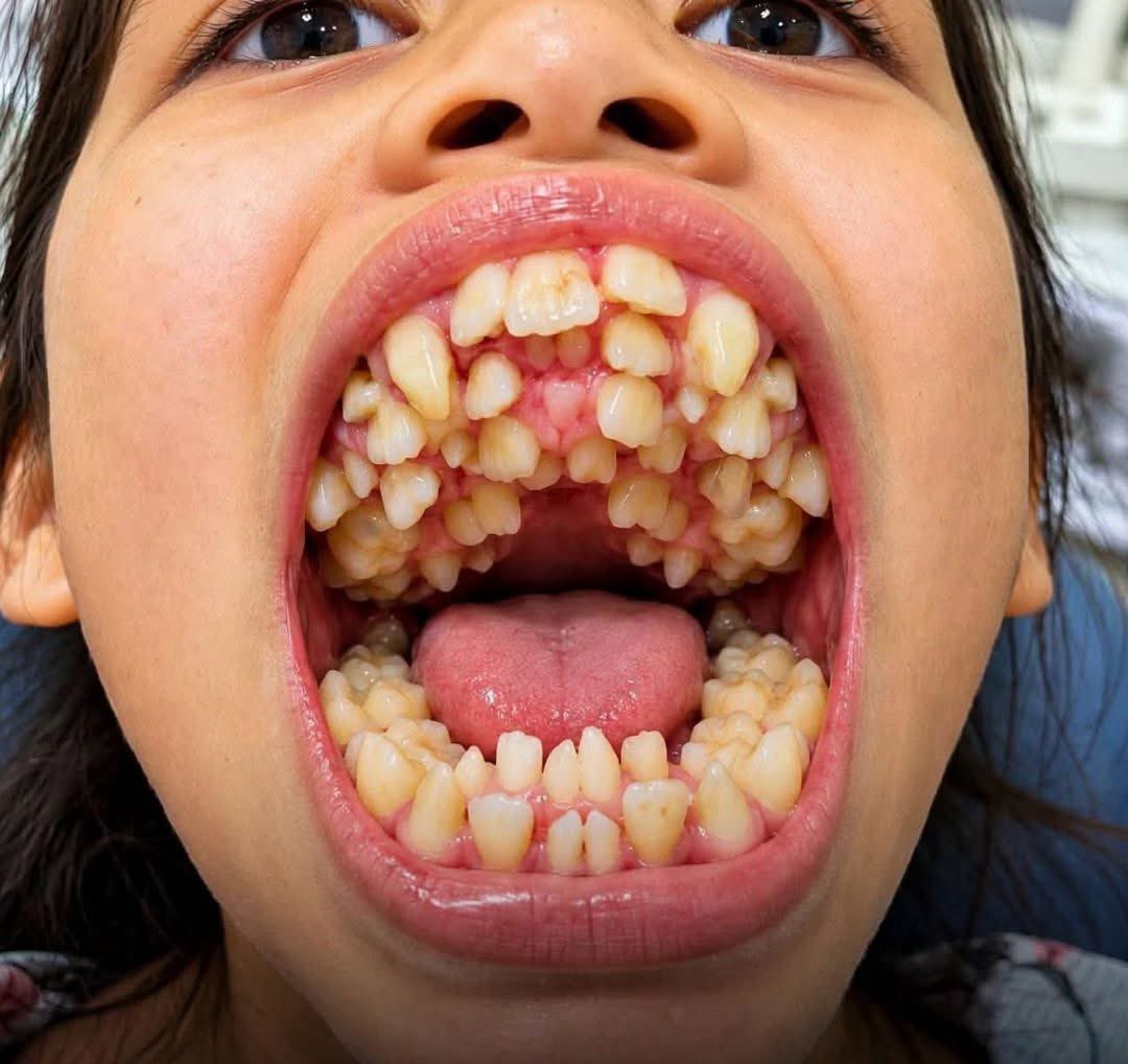 AnnUdoh5's tweet photo. Hyperdontia is a dental condition in which a person develops more teeth than the normal number. These extra teeth are called supernumerary teeth.

Have you seen one before https://t.co/aBRPdSeZZb