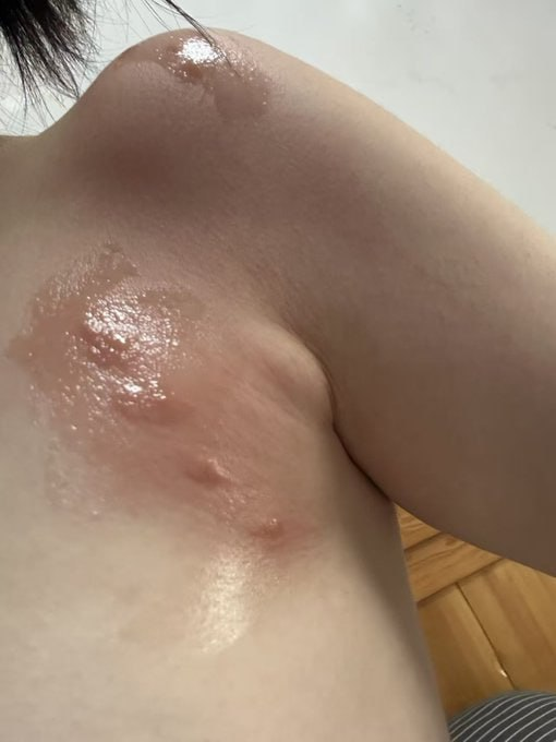 Marvo_600's tweet photo. 测试版真的有用吗
爱爱后身上长了荨麻疹一样 痒痒的 https://t.co/HMVUCuvXyU