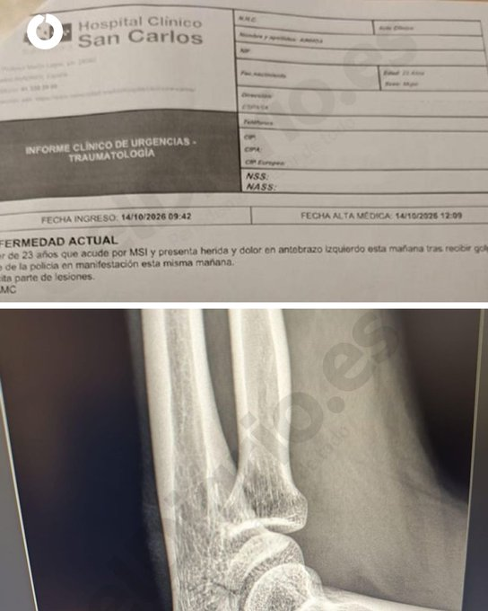 JulianMaciasT's tweet photo. La estudiante a la que la policía le ha roto el cúbito mientras se manifestaba por la educación pública denunciará al agente que le agredió, asegura que puso el brazo para protegerse porque el porrazo iba a la cara.
https://t.co/kYJlG1klmC https://t.co/ZE4rtrr7ky