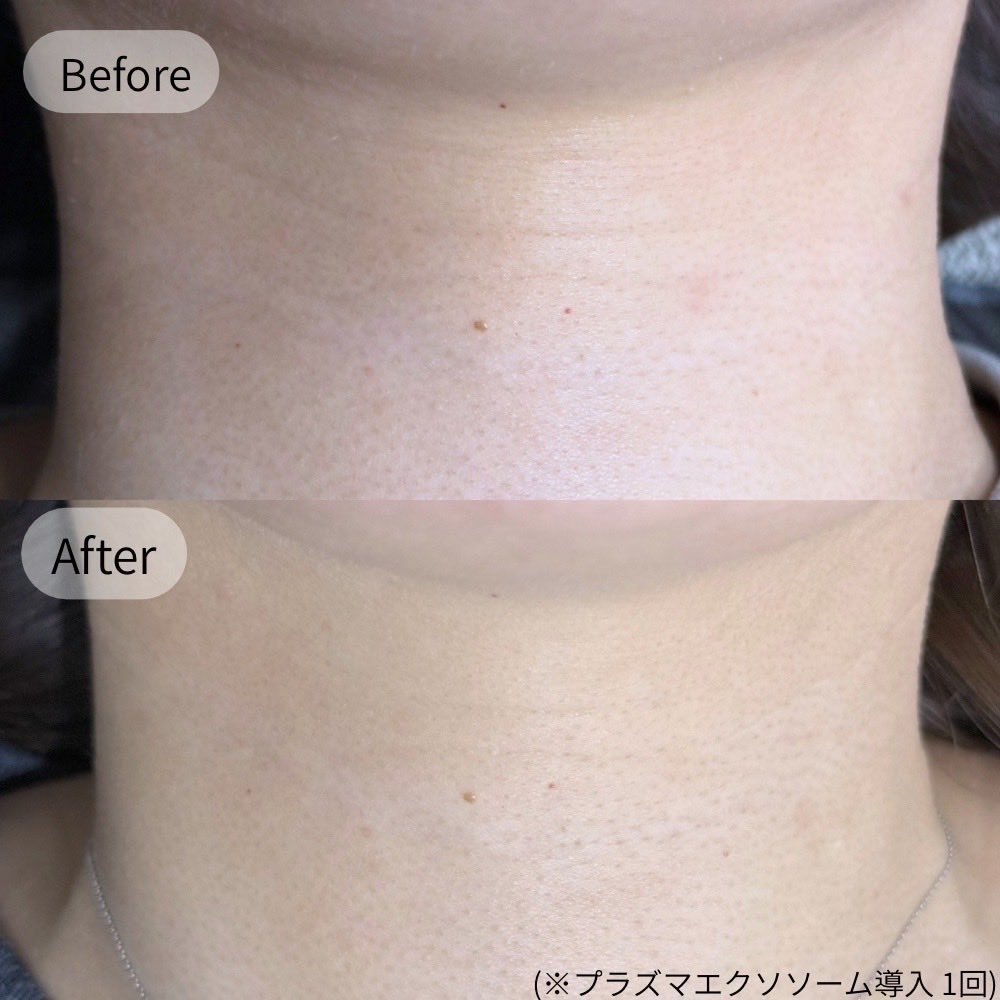 gpAdqVXdgi's tweet photo. 昔からずっと悩んでいた首の皺、1回でこんなに薄くなった😭しかもこれでもまだ効果のピークではないみたいなので楽しみ...
@hikari_esthe https://t.co/qaCbDSp8oA