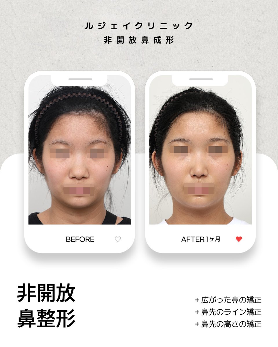 lejclinic's tweet photo. 鼻先が丸くぼってりしていたり、小鼻が広がって鼻が大きく見えることにお悩みではありませんか？ルジェイクリニックのクローズ法による「セルピックコ（セル픽코）」で、鼻柱の外側に切開跡を残さず、すっきりとシャープで高さ��ある鼻先を目指しましょう！🤍
#韓国鼻整形 #アイドル鼻整形 https://t.co/gKx4TsFoDj
