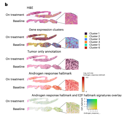 quimmateo's tweet photo. Our #ZZFIRST trial is out today in @NatureMedicine! An academic randomized phase II trial of Talazoparib + Enzalutamide in high-volume mHNPC integrating spatial transcriptomics on longitudinal tumor biopsies. Thanks to all patients and funding from DoD/CDMRP + @ContraCancerEs https://t.co/rkwcKjQjCF