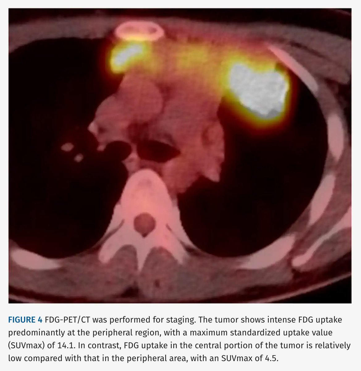 JTIJournal's tweet photo. 🫁 New in #JTI: An unusual CT appearance of Hodgkin lymphoma!

🩻 Namihira et al describe an anterior mediastinal mass with abundant intratumoral vessels.
🩸CT-guided biopsy was complicated by hemothorax.
💡Assess tumor vascularity before biopsy.

Article 🔗 in reply! https://t.co/XnoP0gz5bp