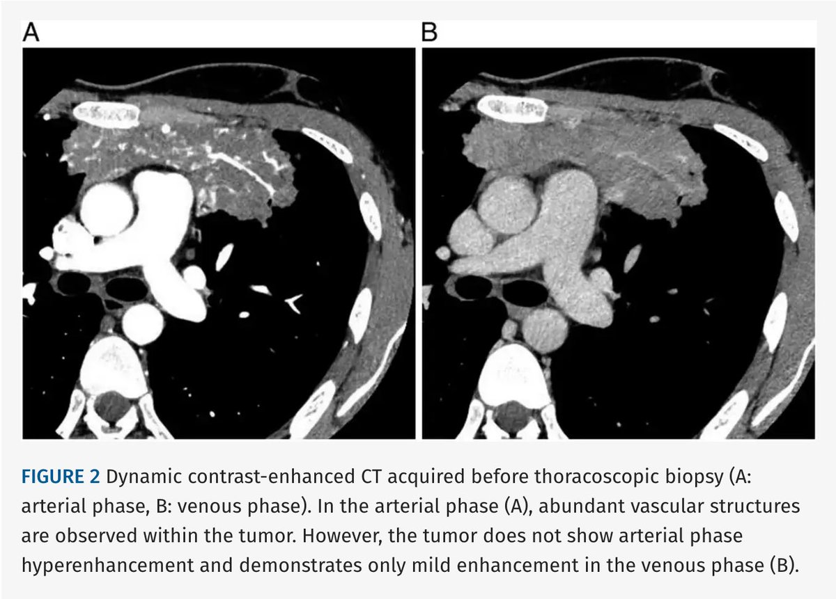 JTIJournal's tweet photo. 🫁 New in #JTI: An unusual CT appearance of Hodgkin lymphoma!

🩻 Namihira et al describe an anterior mediastinal mass with abundant intratumoral vessels.
🩸CT-guided biopsy was complicated by hemothorax.
💡Assess tumor vascularity before biopsy.

Article 🔗 in reply! https://t.co/XnoP0gz5bp