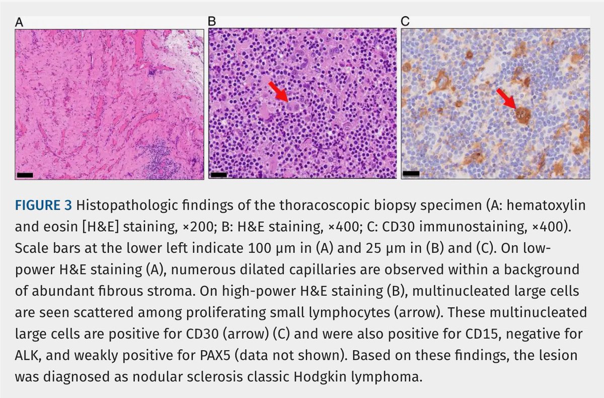 JTIJournal's tweet photo. 🫁 New in #JTI: An unusual CT appearance of Hodgkin lymphoma!

🩻 Namihira et al describe an anterior mediastinal mass with abundant intratumoral vessels.
🩸CT-guided biopsy was complicated by hemothorax.
💡Assess tumor vascularity before biopsy.

Article 🔗 in reply! https://t.co/XnoP0gz5bp