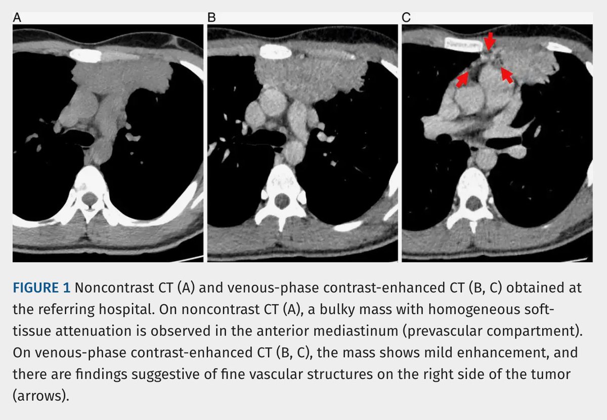 JTIJournal's tweet photo. 🫁 New in #JTI: An unusual CT appearance of Hodgkin lymphoma!

🩻 Namihira et al describe an anterior mediastinal mass with abundant intratumoral vessels.
🩸CT-guided biopsy was complicated by hemothorax.
💡Assess tumor vascularity before biopsy.

Article 🔗 in reply! https://t.co/XnoP0gz5bp