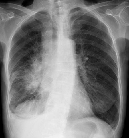 RadMasterclass's tweet photo. CHEST X-RAY 33: Shortness of breath and haemoptysis. Describe as many abnormalities as you can. What is the likely diagnosis? Answer https://t.co/qTT88AgczM https://t.co/DbpfzSdQcs