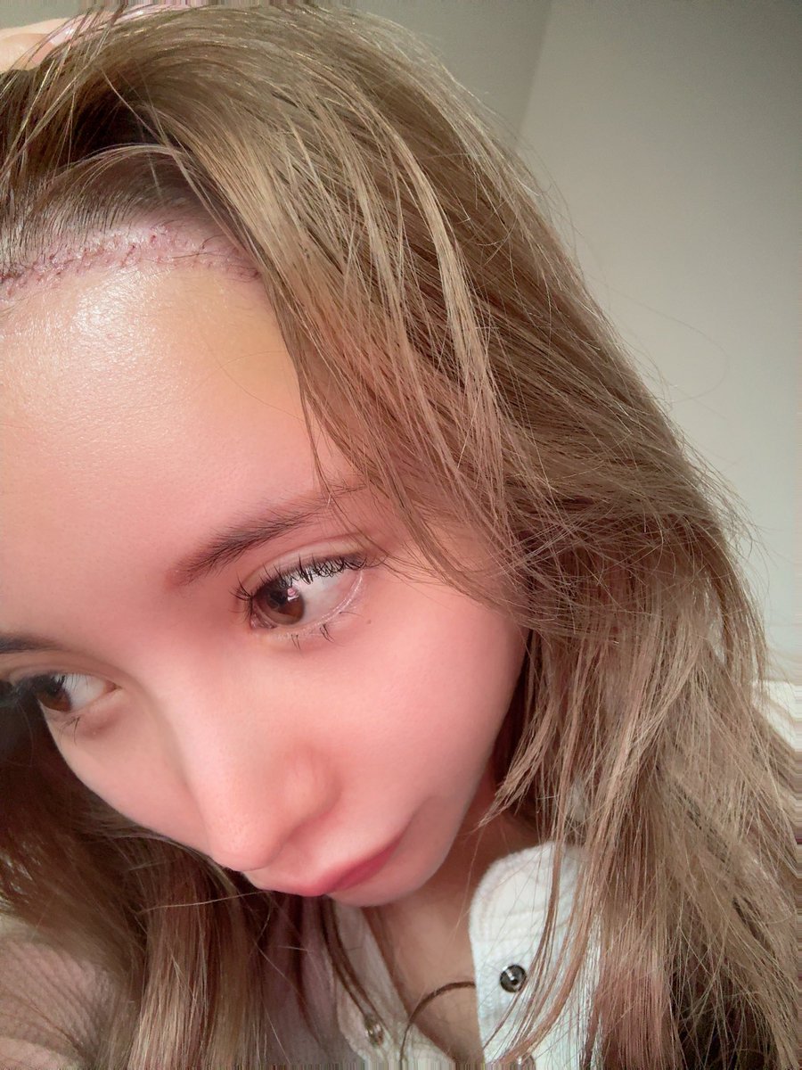 22kp08's tweet photo. 縫い目🧵注意
抜糸完 https://t.co/tKcnNYoK8h