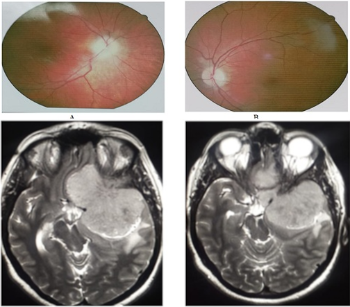 DocNavarrow's tweet photo. 👩‍🦰A 25-year-old woman, 6 months pregnant, presents with 4 months of progressive left-eye visual loss, rapidly worsening over the past week, with new right-eye visual deterioration and frontal headaches. 

🧑‍⚕️Which syndrome do you suspect? https://t.co/IwcrUIIZDP