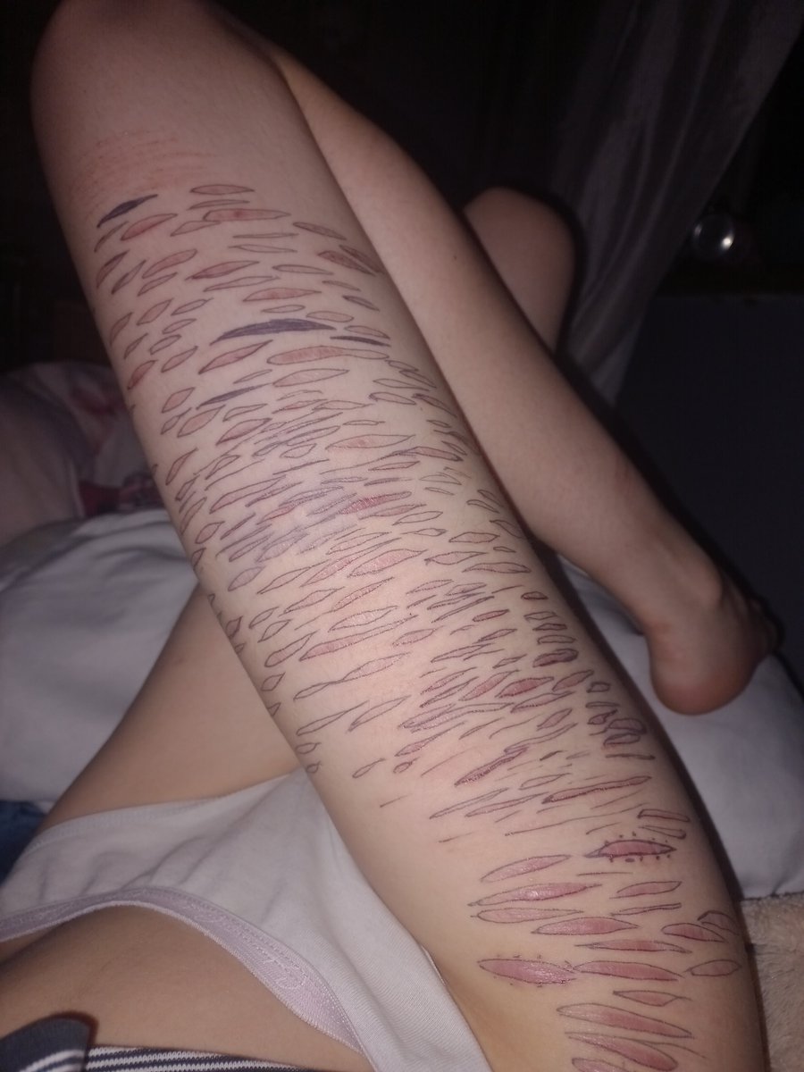 LadyBugBugsie's tweet photo. Just counted and I have 210 scars on my right thigh! Forgot the lower ones but I'd add it up to 220 maybee!
I drew over them So it would be a bit easier to countt 
#shedtwt https://t.co/ycsUtWyAXP
